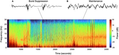 Burst Suppression During General Anesthesia and Postoperative Outcomes: Mini Review